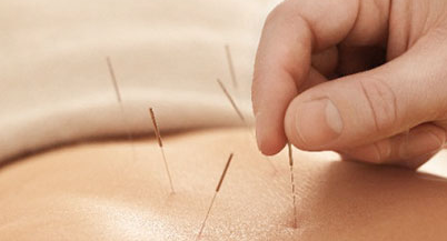 Acupuncture